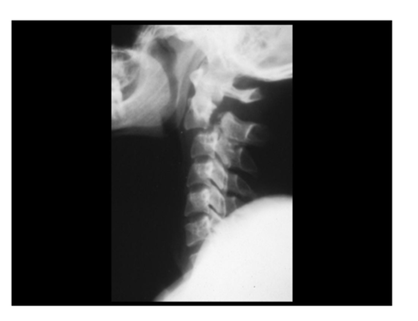 <p>bilateral pars interarticularis fracture of C2 - leaves dens unstable</p><p>- like a spondy in lumbar but in cervical</p>