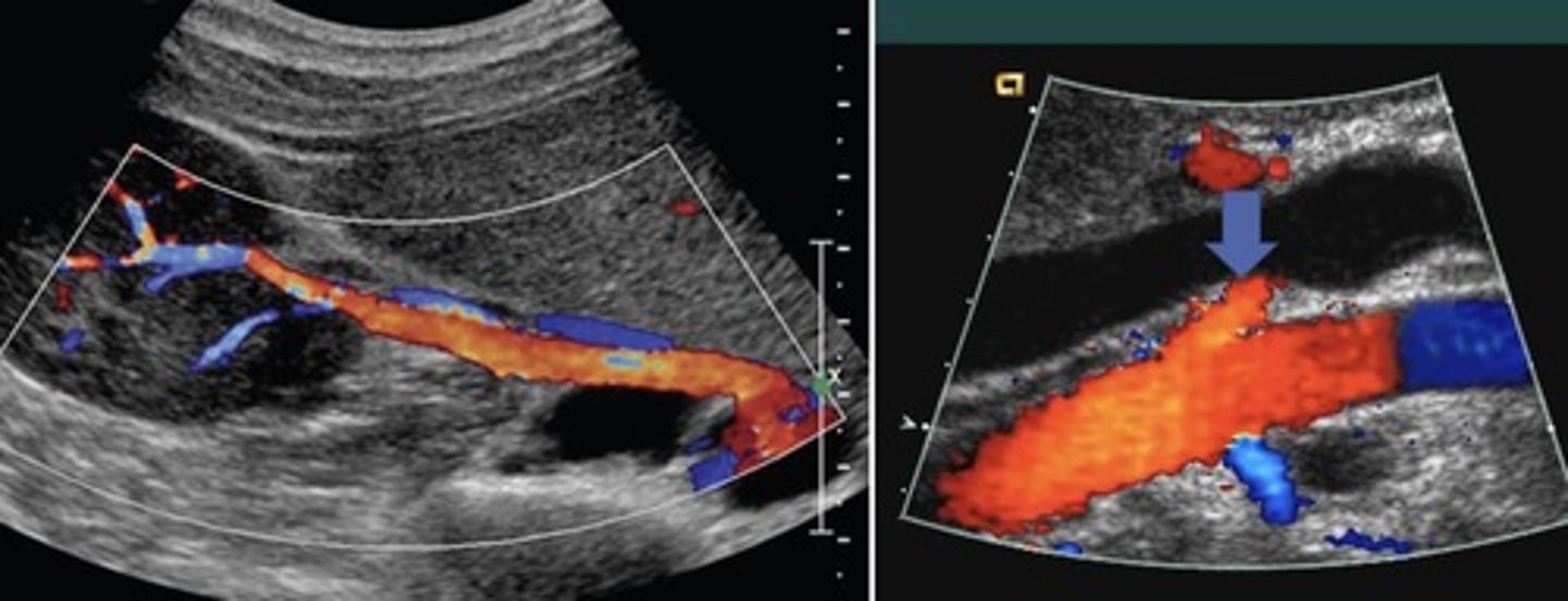 <p>Posterior to IVC and RRV</p>