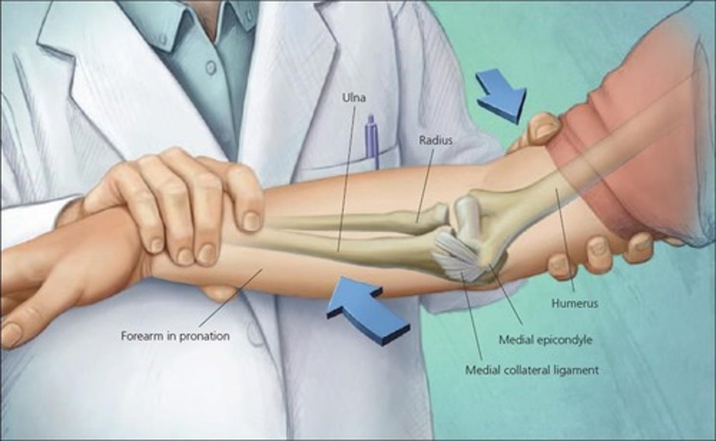 <p>medially directed force at elbow, and laterally directed force at wrist</p>