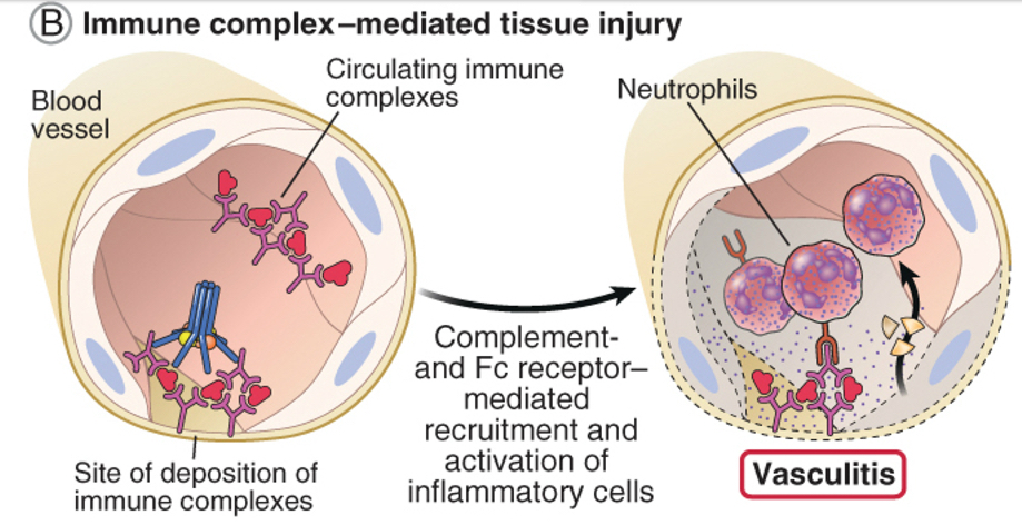 <p>Largest amounts of immune complexes can lead to tissue-damaging type lll reactions.</p><ul><li><p>Local: complexes deposited at the site of antigen entry cause localized reaction</p></li><li><p>Systemic: reactions can also develop wherever the complexes are deposited in blood vessel walls, synovial membranes in joints, glomerular basement membrane in the kidney, and choroid plexus in brain, initiating the neutrophils and granular release.</p></li></ul><p>Immune complexes initiate the complement system.</p><p></p>