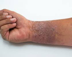 <p>A hereditary condition causing inflammation of the skin, also known as eczema.It is characterized by dry, itchy skin and can lead to skin infections. </p>