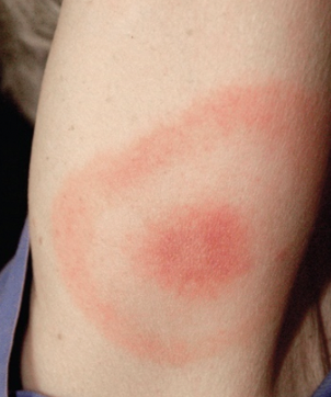 <p><span style="background-color: transparent;"><strong><span>Lyme Disease </span></strong></span></p>