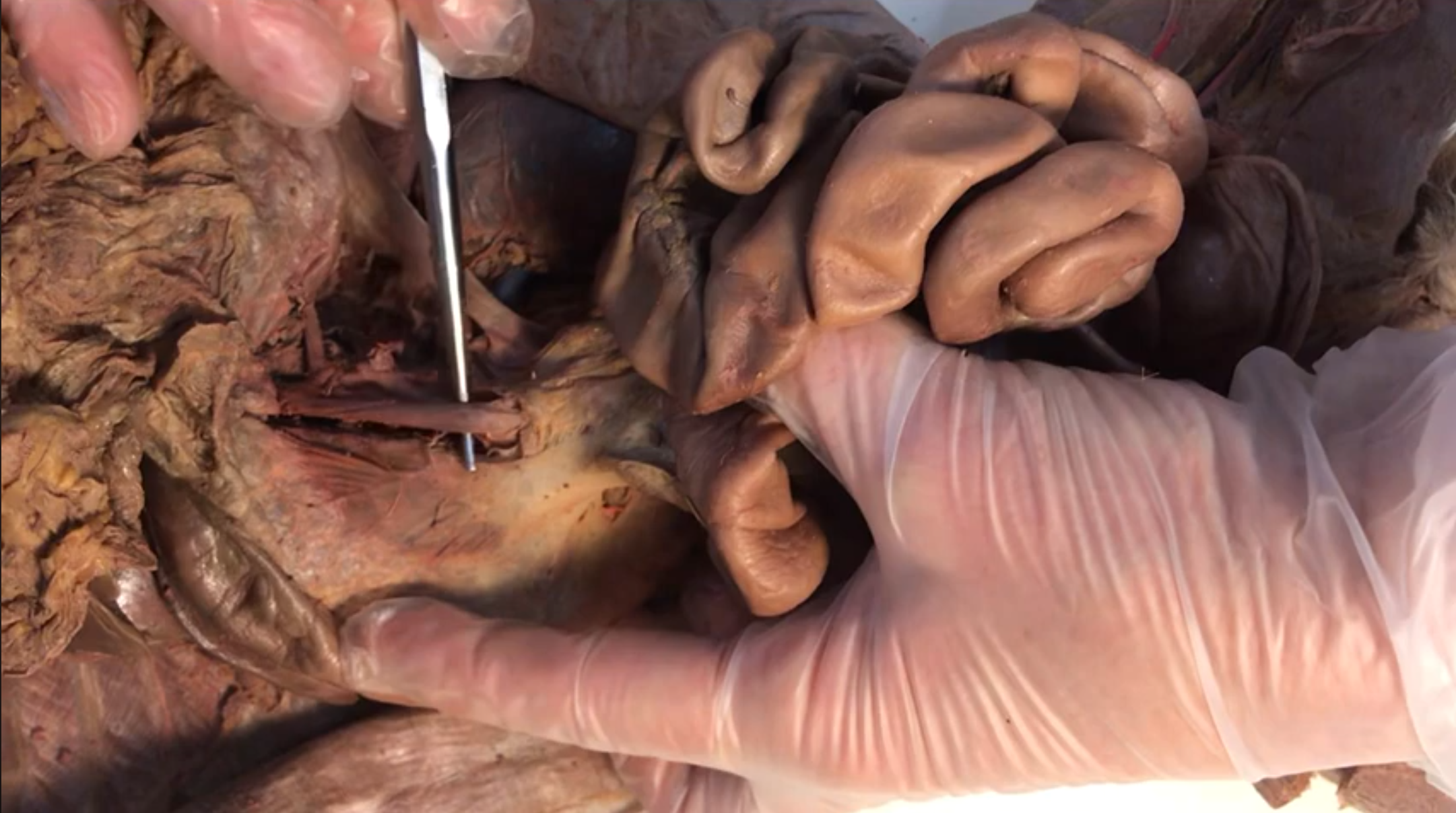 <p>What vein is this</p>