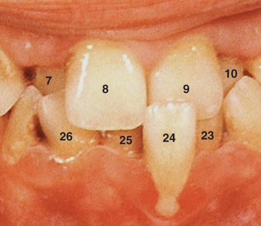<p>50. What terminology would you use to describe the location of tooth #24 seen in Fig. 5.31?</p><p>a. Torsiversion</p><p>b. Infraocclusion</p><p>c. Labioversion</p><p>d. Linguoversion</p>