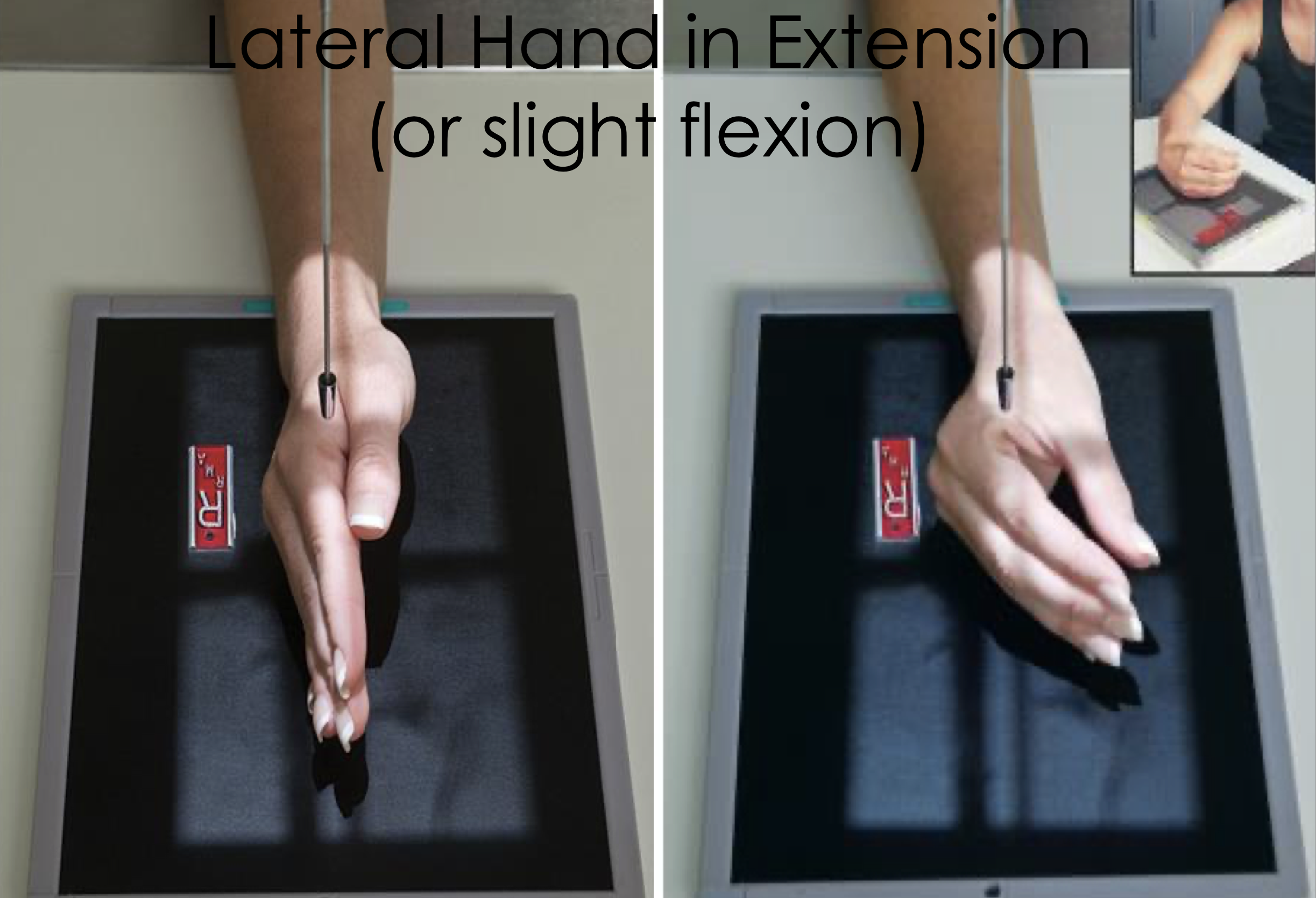 <ul><li><p><span style="line-height: normal;"> </span>Same basic positioning and centering as “fan” lateral</p></li><li><p class="p1"><span style="line-height: normal;"> </span>Fingers are extended and superimposed</p></li><li><p class="p1"><span style="line-height: normal;"> </span>May be used for detection of foreign bodies or to better visualize anterior/posterior displacement fractures of the metacarpals</p></li><li><p class="p1"><span style="line-height: normal;"> </span>Fingers can be flexed slightly if extension is too painful</p></li><li><p class="p1"><span style="line-height: normal;"> </span>Thumb is in a PA</p></li></ul><p></p>
