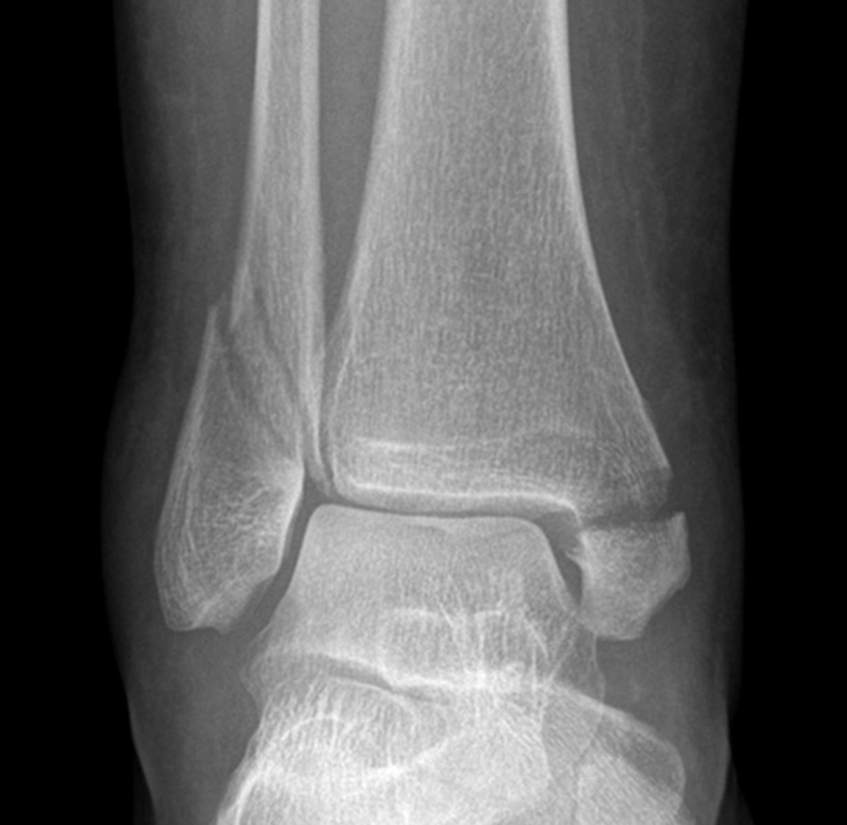 <p>Fractures of both the medial and the lateral malleolus.</p>