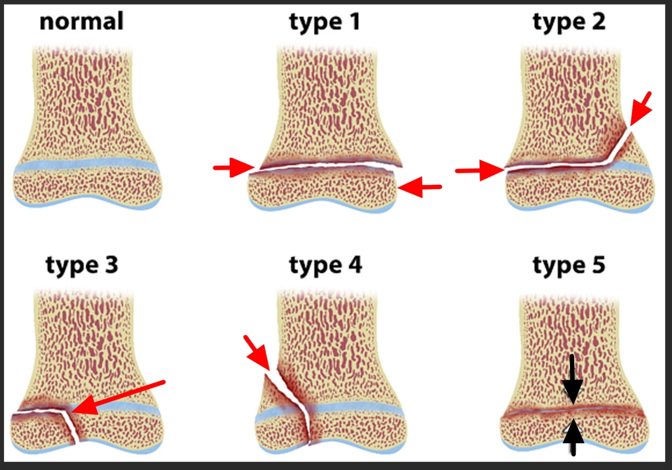 <p>What is an epiphyseal bone fracture?</p>