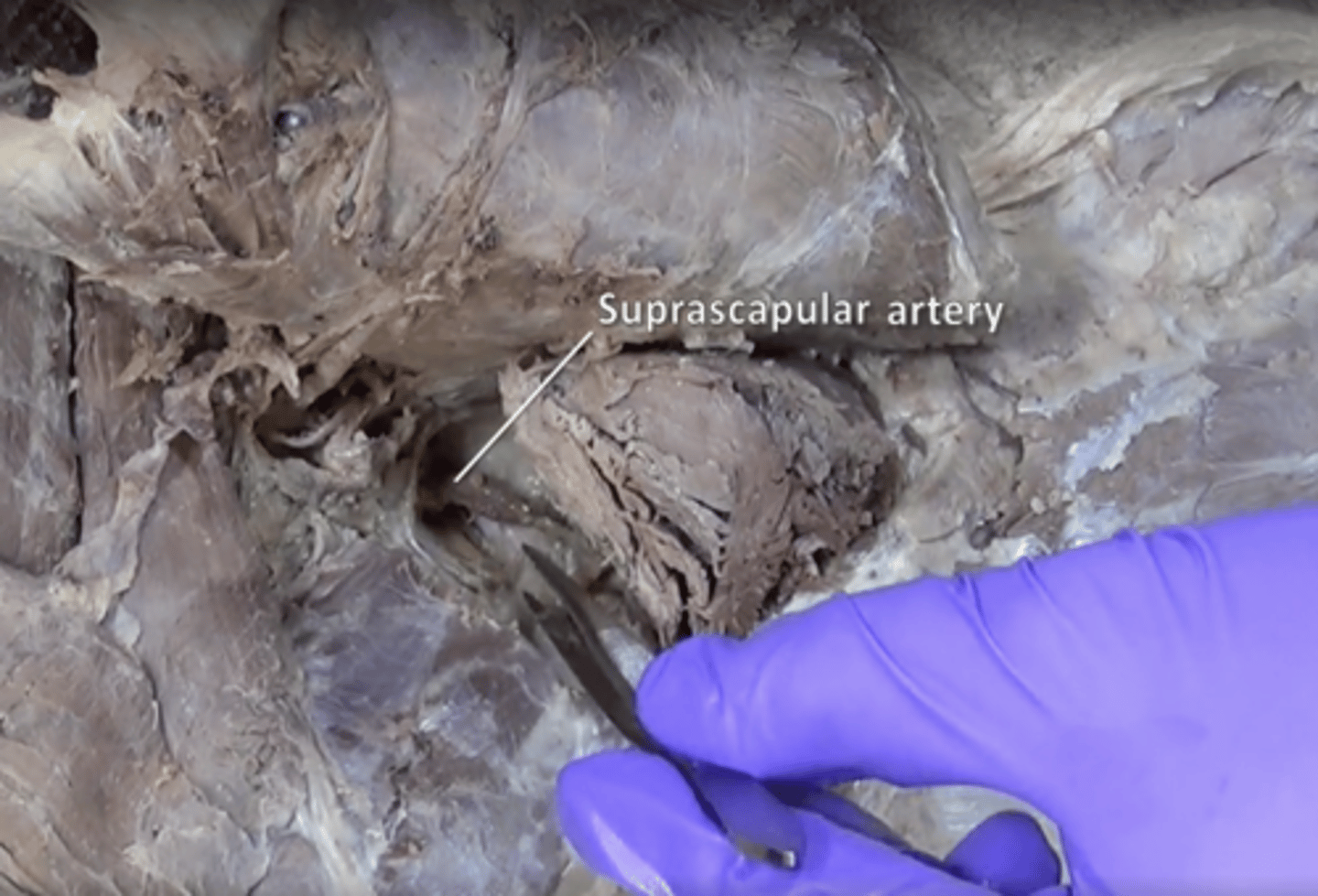 <p>supplies supraspinatus and infraspinatus. Located above teres minor and underneath spinatus muscles</p>