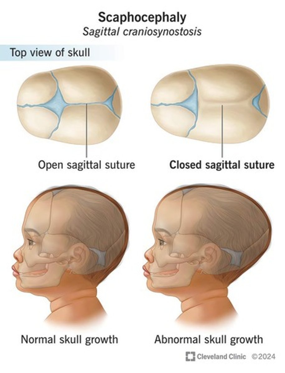 <p>Premature closure of cranial sutures, which are joints where skull bones form and fuse, typically occurring around age 2.</p>