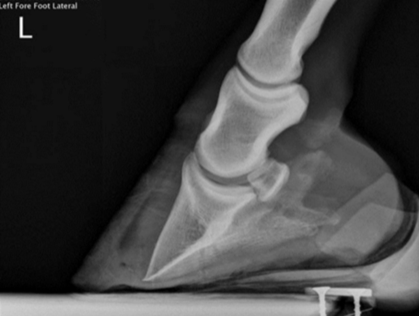 <p>In which limb does this typically occur?</p>