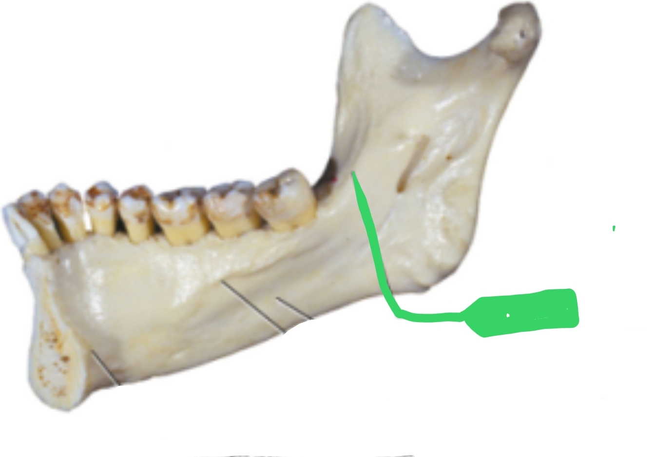 <ul><li><p>Also called Mylohyoid Ridge</p></li><li><p>Located on inside of mandible</p></li><li><p>Muscles attach here</p></li></ul><p></p>