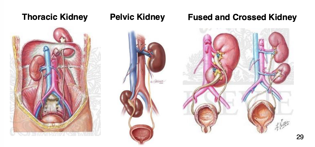 <ul><li><p>kidney is located in an abnormal position</p></li><li><p>there are several different variants depending on location</p></li><li><p>usually doesn’t cause issues</p></li><li><p>less often, the ectopic kidney may cause problems such as urine blockage, infection, or urinary stones</p></li></ul><p></p>