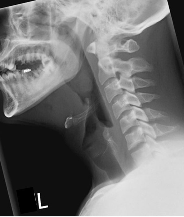 <p>From the EAM to jugular notch (or nasopharynx to clavicles), including anterior and posterior surfaces of the neck.</p>