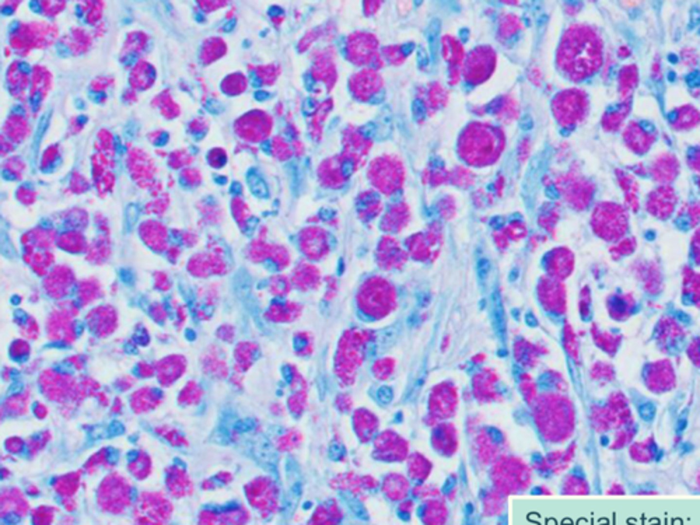<p>What kind of granuloma is this? What is this special stain showing?</p>