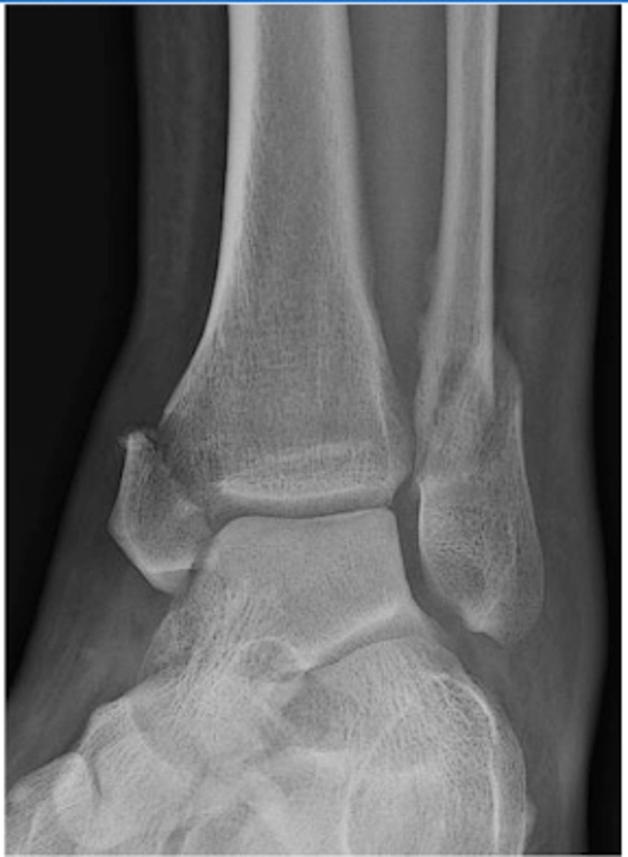 <p>involves BOTH the medial and lateral malleolus</p>