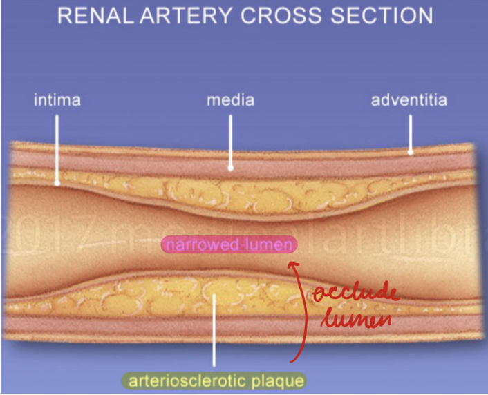 <p>90%</p><p>Mostly men > 50 years</p><p>Aterionephrosclerosis: Atherosclerotic plaques in renal arteries</p>