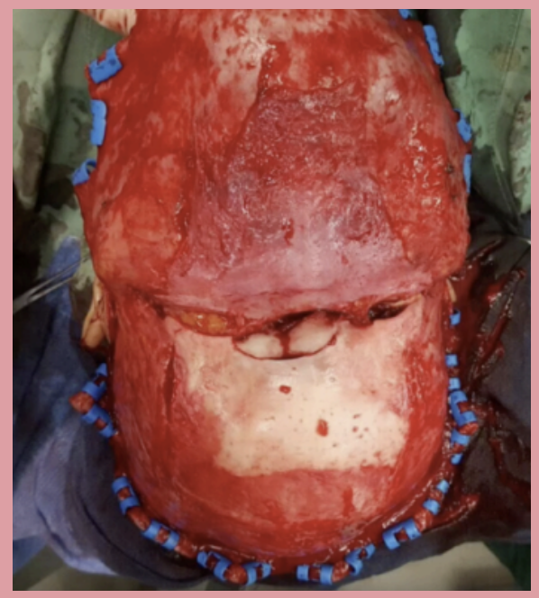 <p>Intraoperative photo showing the scalp peeled back to reveal a what tye of fracture. The blue clips lining the edge of the cut scalp are necessary in order to prevent bleeding from the rich blood supply.</p>