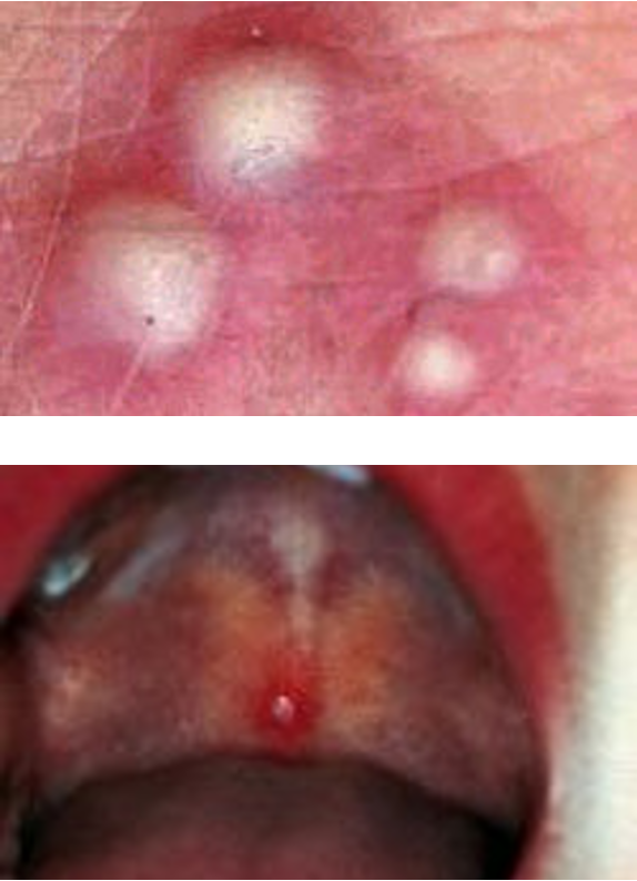 <p>superficial skin cavity containing purulent exudate; may be yellow, white, green-white, or hemorrhagic</p><p>(vesicle or bulla containing purulent fluid)</p>