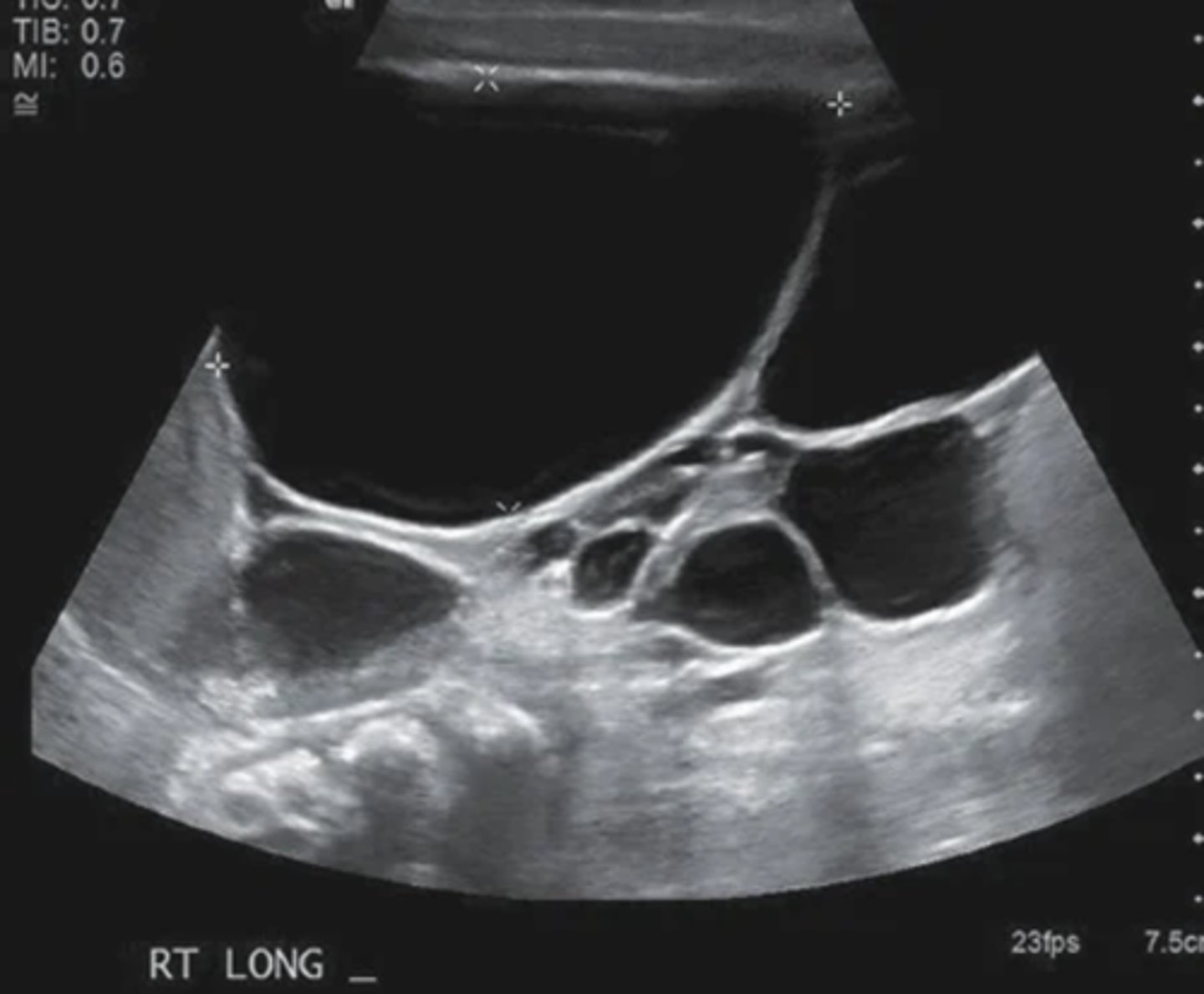 <p>- ureteral atresia</p><p>- contralateral UPJ</p><p>- nonfunctioning kidney</p><p>- absent renal artery</p>