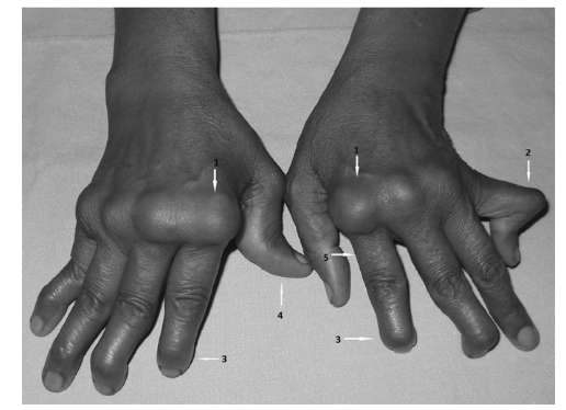 <p>What disease is shown in a <strong>late-stage image</strong> with <strong>joint deformities</strong>?</p>