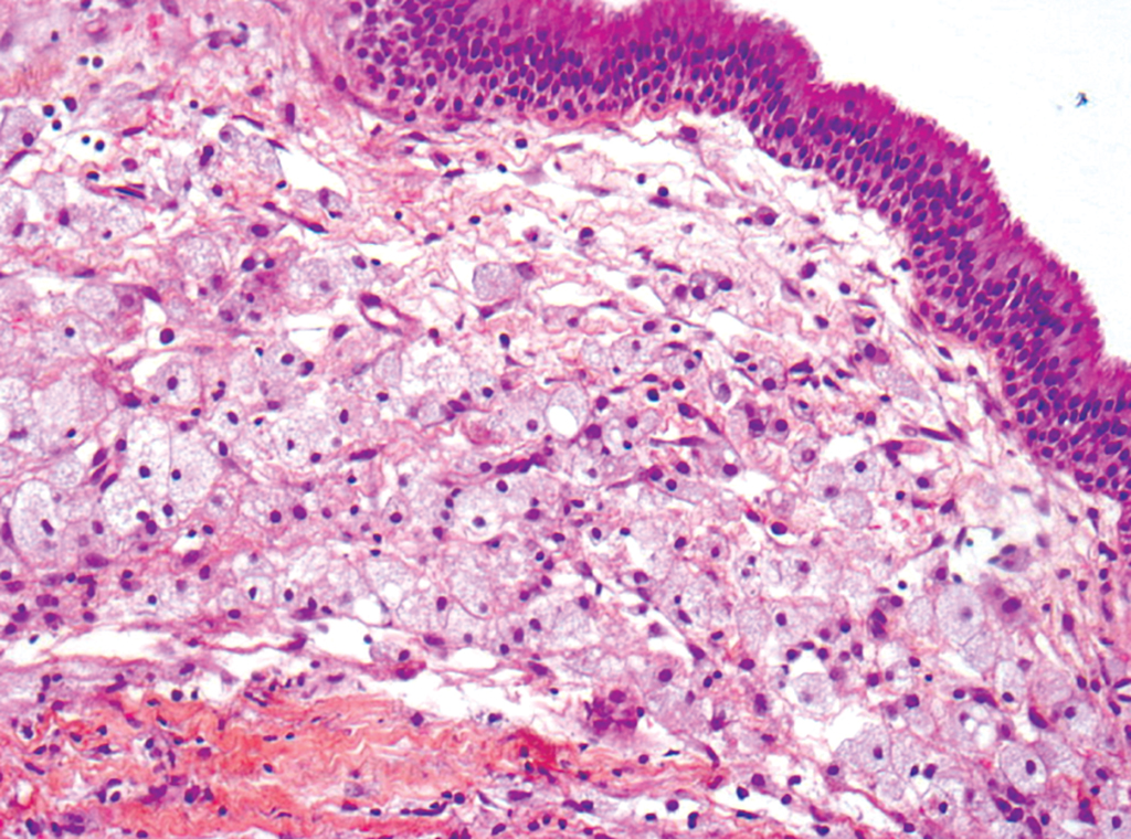 <p>Patient avec sclérose des os longs + masse ORL </p><p>1) Diagnostic </p><p>2) Localisation </p><p>3) Histo </p><p>4) IHC </p><p>5) moléculaire </p>