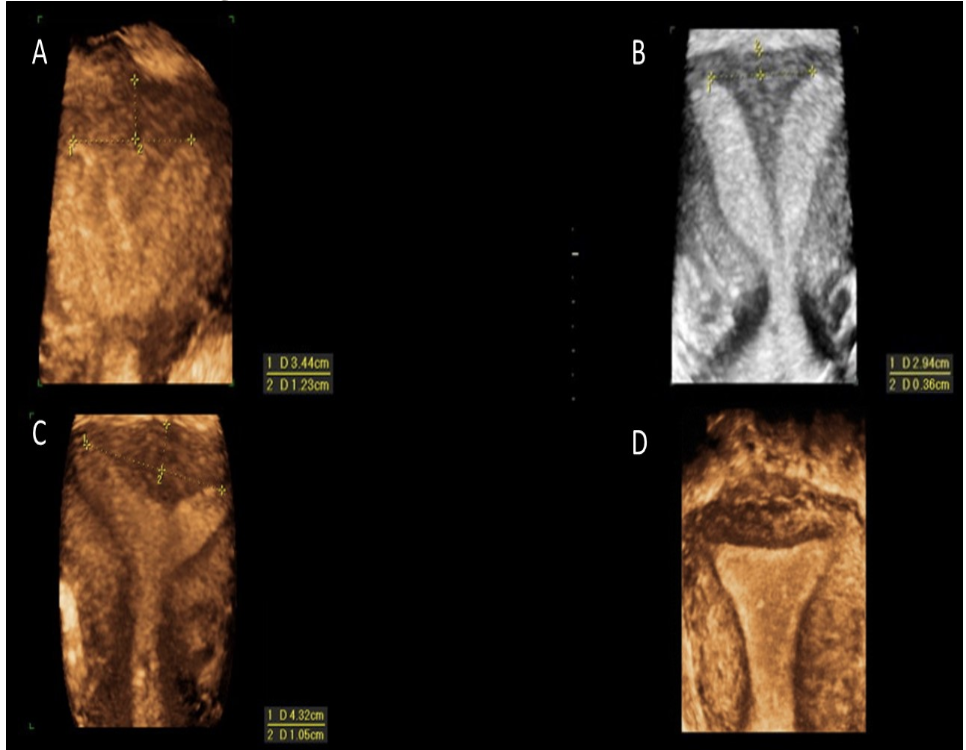 <p>which shows <strong>arcuate</strong> uterus</p><p>a) A</p><p>b) B</p><p>c) C</p><p>d) D</p>