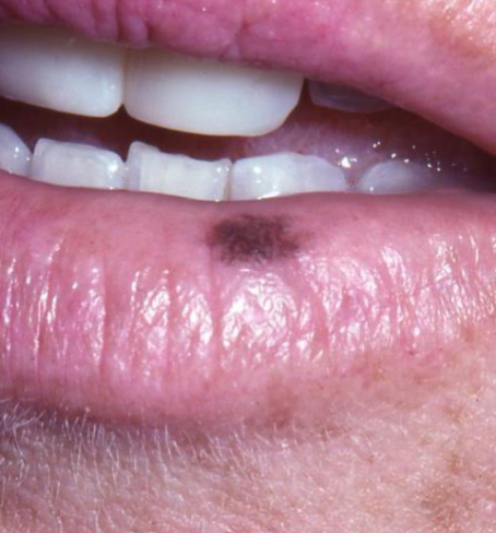 <p>benign focal increase in MELANIN deposits, <strong>NO change with UV </strong></p>