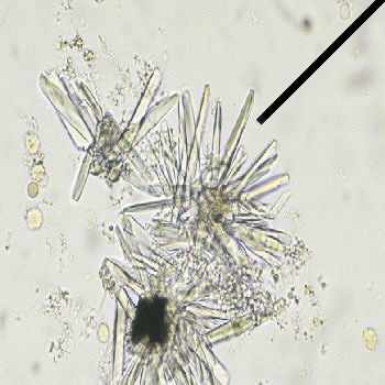 <ol><li><p>Identify pointed structure found in alkaline urine.</p></li><li><p>This is a common constituent of?</p></li></ol><p></p>