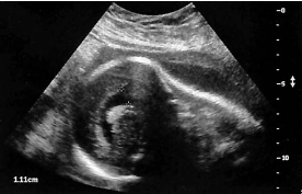 <p><span><span>The sonographic finding in this image is most suspicious for:<br></span></span></p>