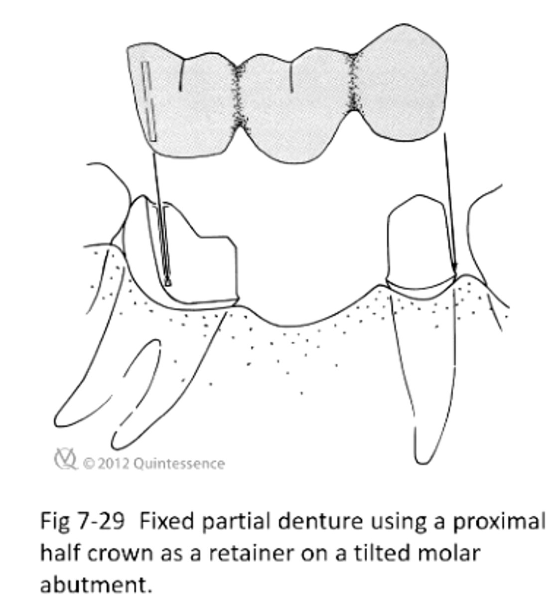 <p>What is another way you can compensate for a mesially tilted molar if you want to make a 3 unit bridge?</p>