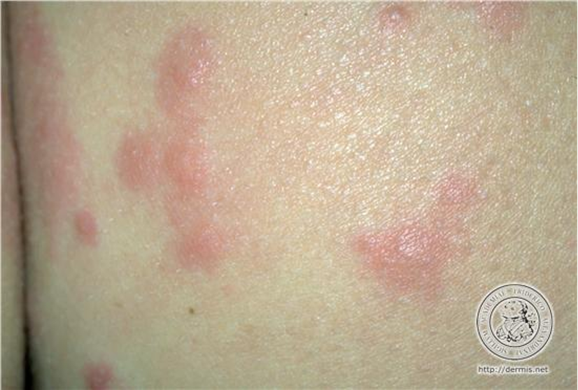 <p>Insect Bites </p>