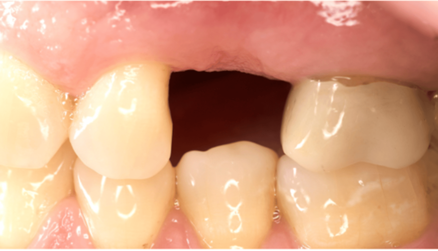 <p>When you evaluate restorative space #4, at least how much space you need to have vertically (occlusal-cervical direction) for screw retained restoration ? (select one).</p><p>A. 7 mm</p><p>B. 5 mm</p><p>C. 6 mm</p><p>D. 4 mm</p>