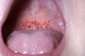 <p>PP: blood escapes capillaries→into tissue</p><p>E: infection<br>decreased platelets<br>trauma</p><p>CM: small red spots<br>non-blanchable<br>in throat</p>