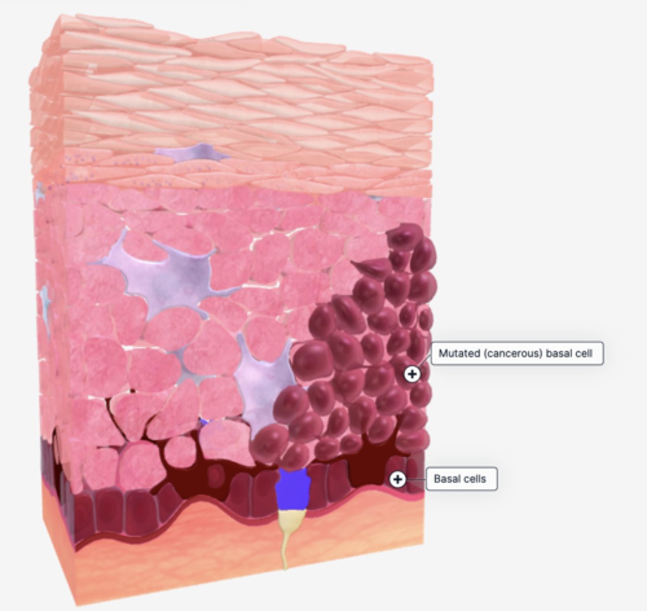 <p>type of skin cancer that originates in the basal cell layer of the epidermis, basal cells are mutated and replicate uncontrollably, they form tumors within the skin and on the surface</p>