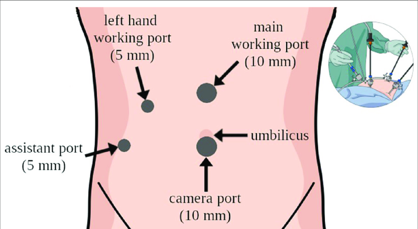 <p>Small incisions made for <strong>laparoscopy</strong>, </p><ul><li><p>where instruments are passed into the abdominal cavity.</p></li></ul><p></p>