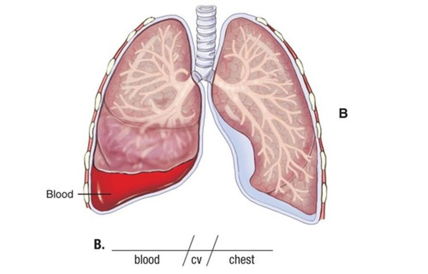 <p>blood in the chest cavity (pleural space)</p>