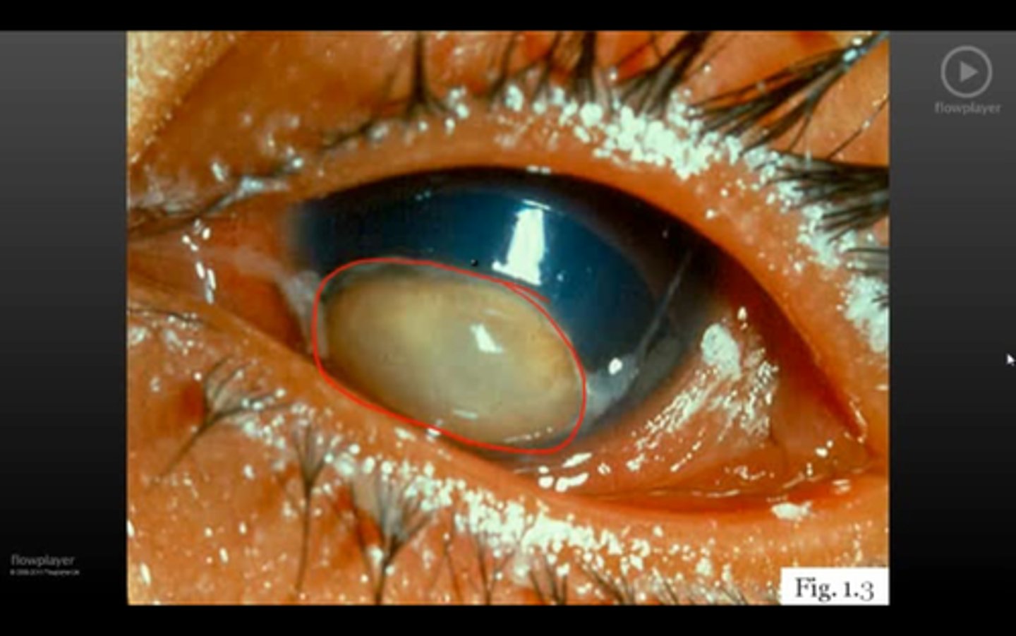 <p>ocular path; cause</p>
