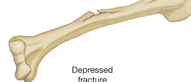 <p>One half of long bone lengthwise is super damaged, other side is clean</p>