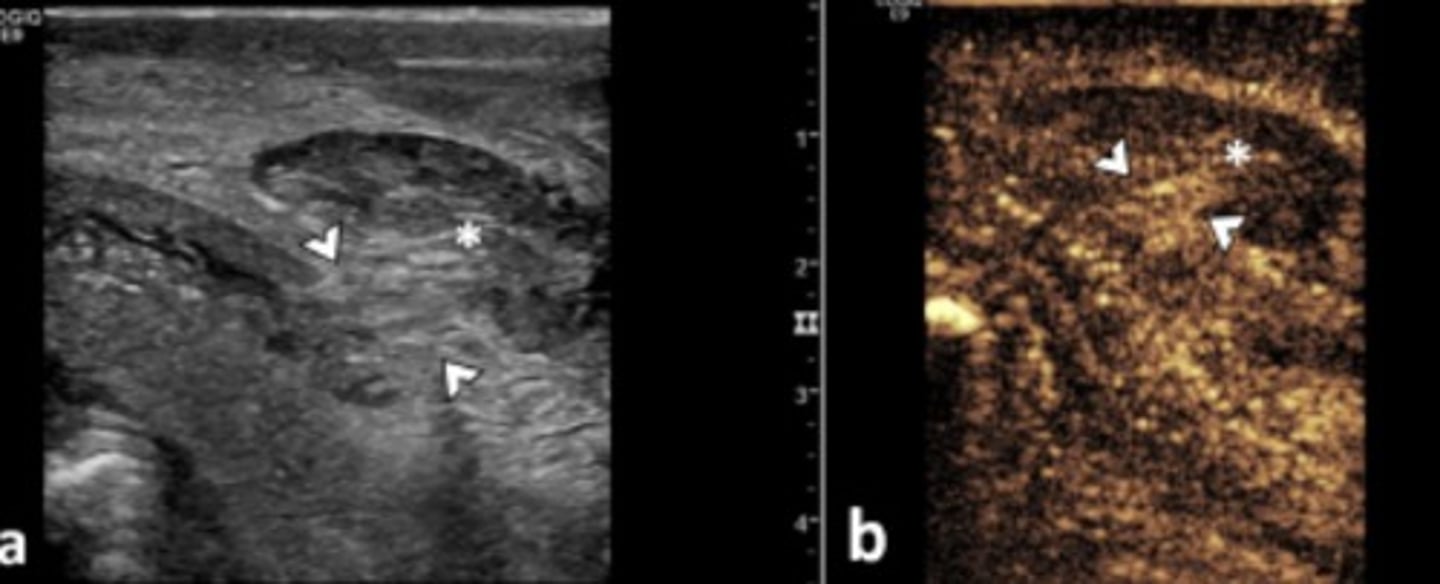 <p>Tear in tunica albuginea (mid or proximal)</p><p>Herniation of cavernosal tissue</p><p>May involve urethra</p>
