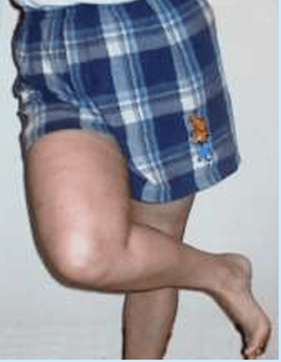 <p>hip flexion, hip adduction, hip ER, knee flexion</p>