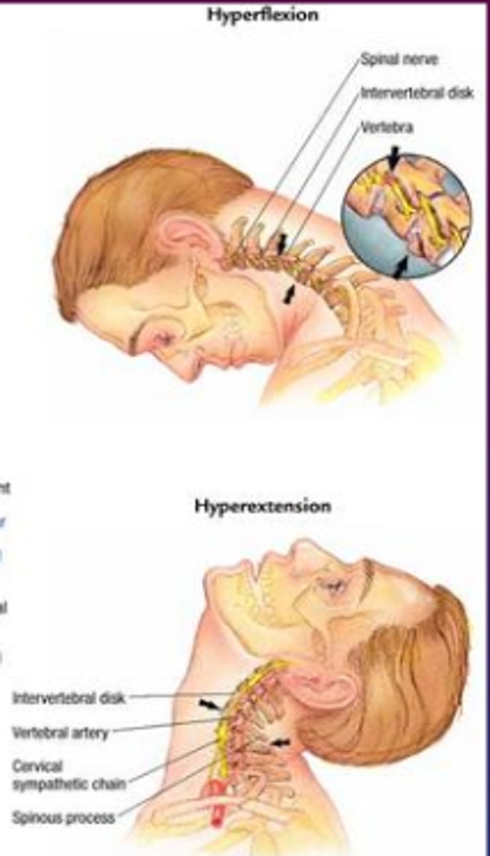 <p>- extension</p><p>- posterior shear</p><p>- posterior compression</p><p>- anterior compression</p><p>- traction</p><p>- torsion is added with any off-center hit</p>
