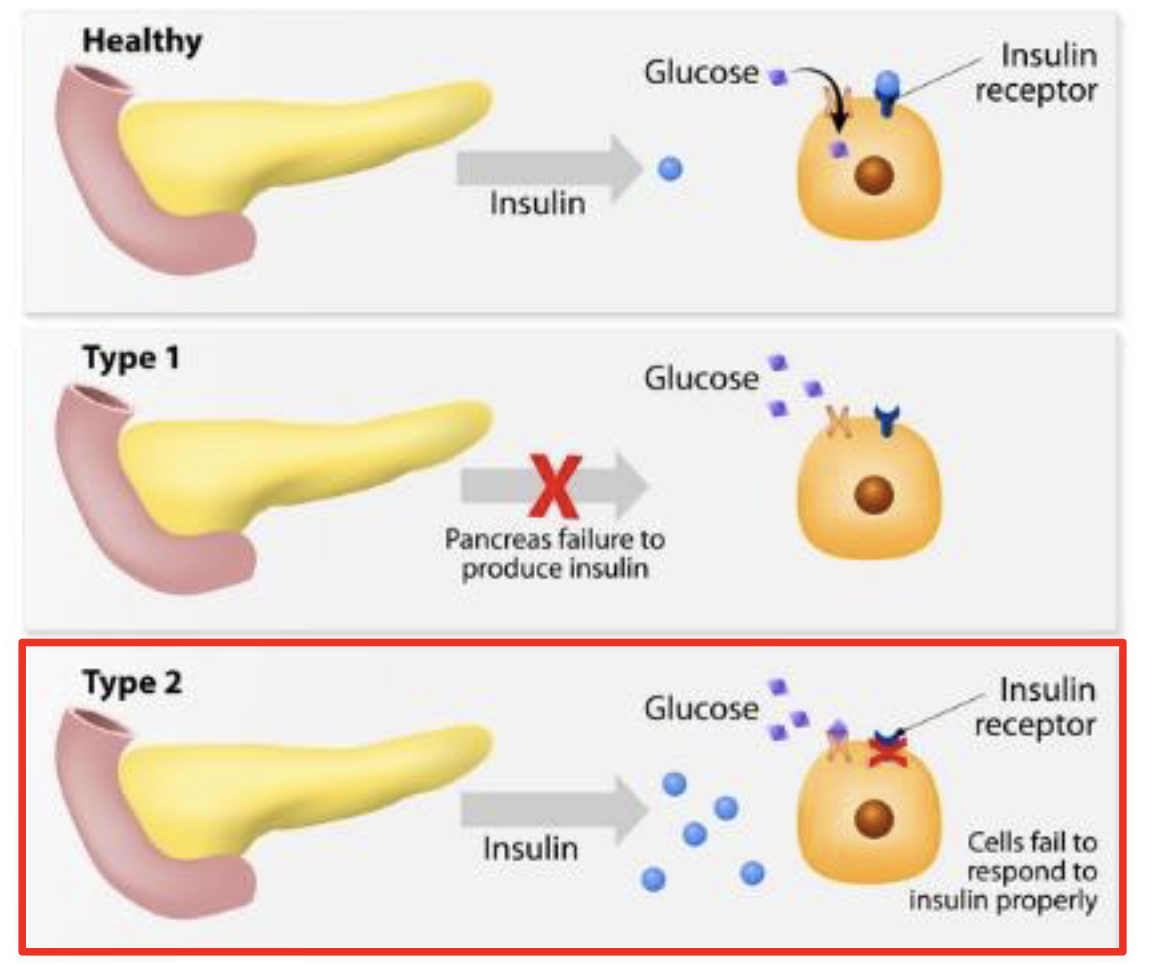 <p>Chronic elevated level of blood glucose increasing insulin but receptors are not responsive</p>
