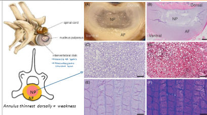 <p>Annulus fibrosus and nucleus pulposus. </p>