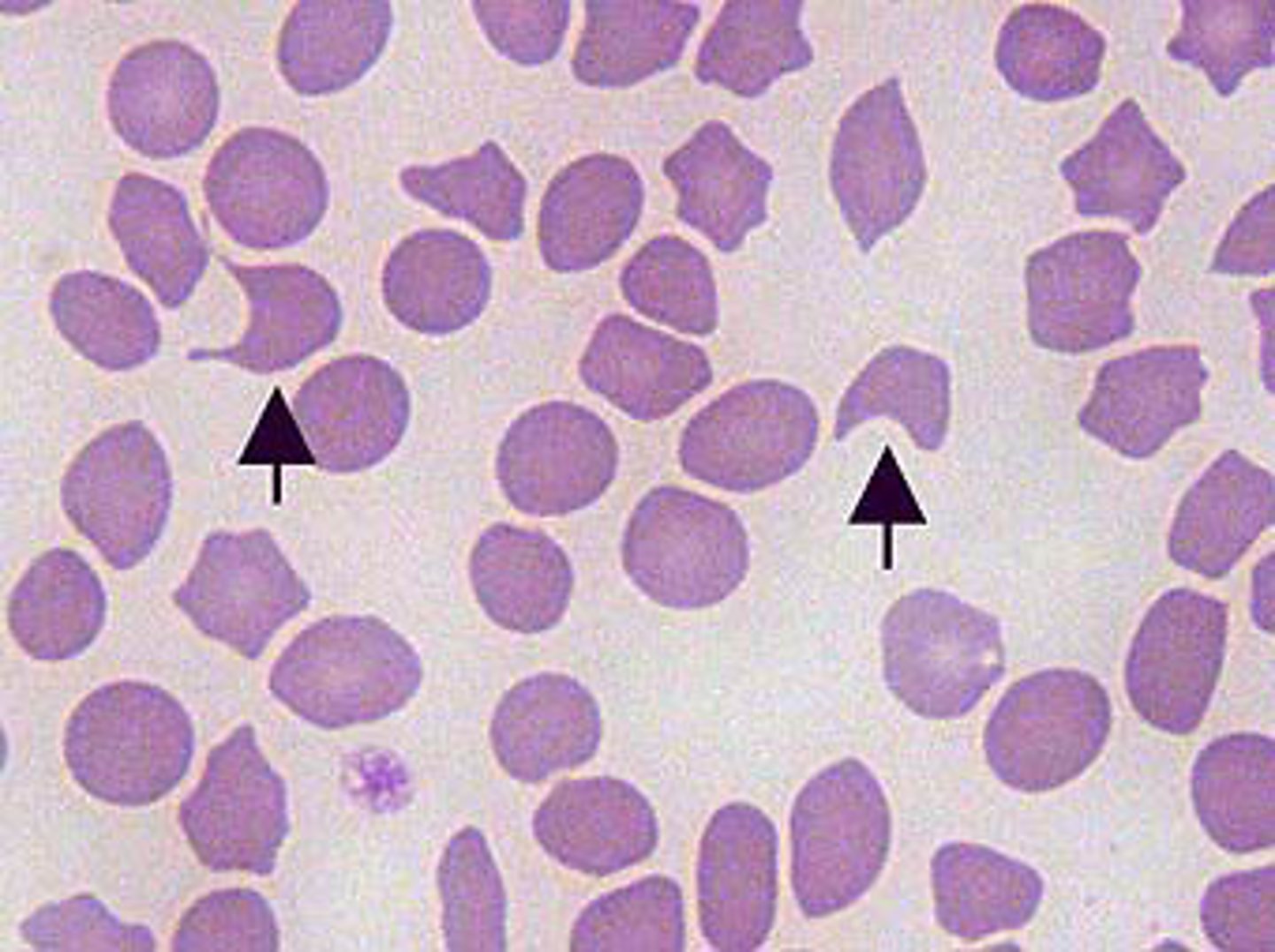 <p>Presence of these cells is associated with hemangiosarcoma, neoplasia, hepatic diseases, and anemia. May appear to have vacuoles. Caused by intravascular trauma</p>