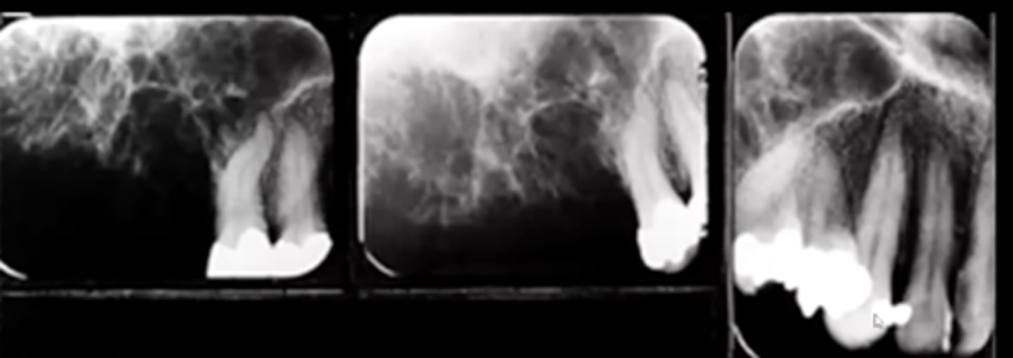<p>appears as a shadow in a radiograph due to slimy substance, but has a "stepladder" pattern</p><p>this means that it contains wispy trabeculae at right angles to each other</p>