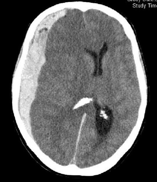 <p>subarachnoid hematoma, stroke, tumor, or subdural hematoma?</p>