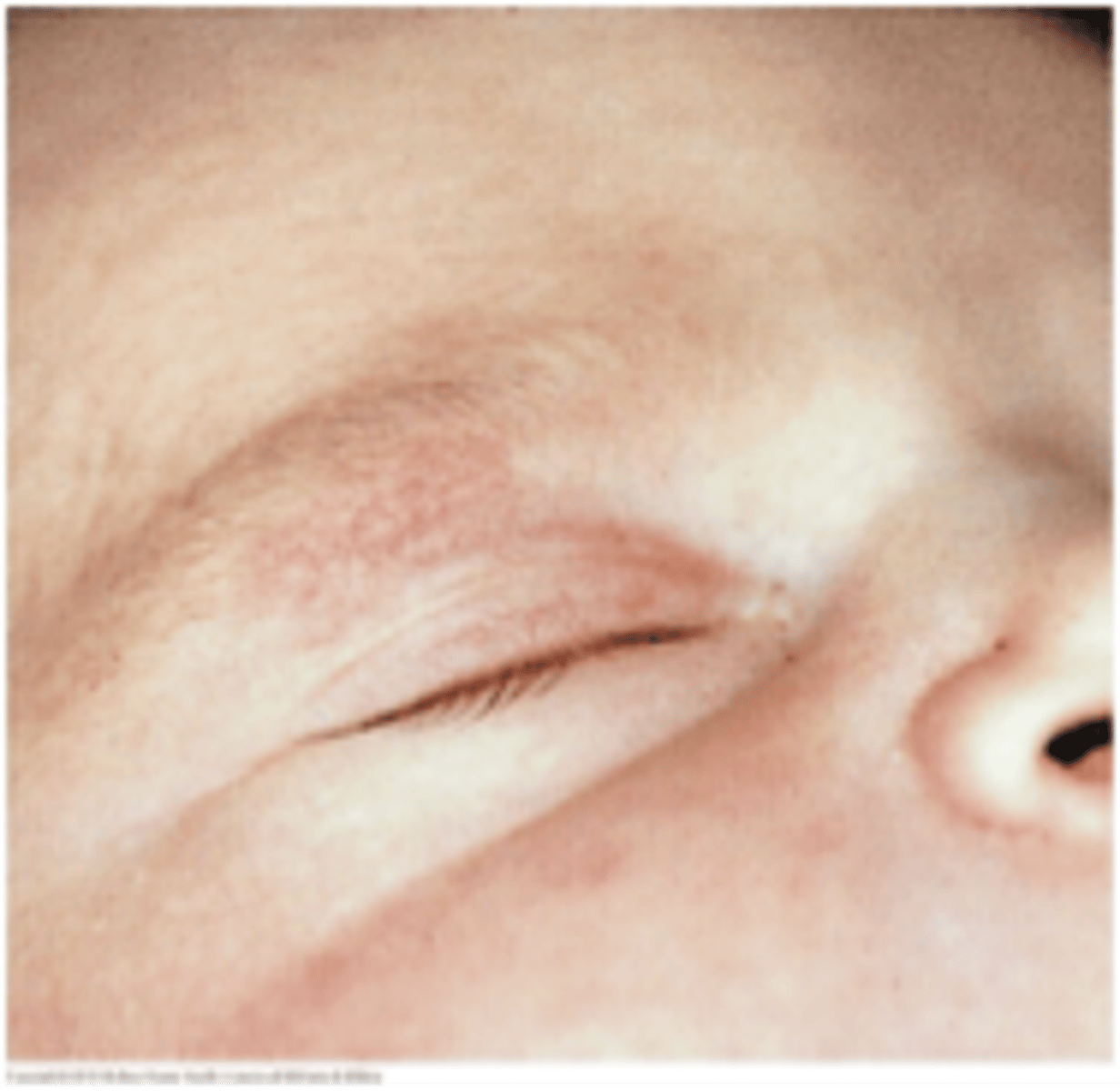 <p>birthmark</p><p>fased within first year of life</p>