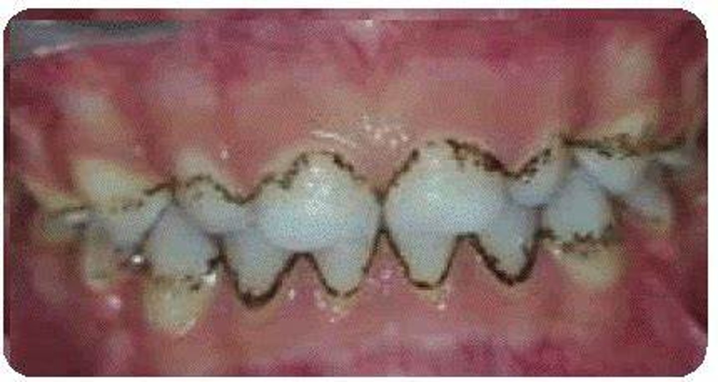 <p>Calculus like stain forms along gingival margin</p>