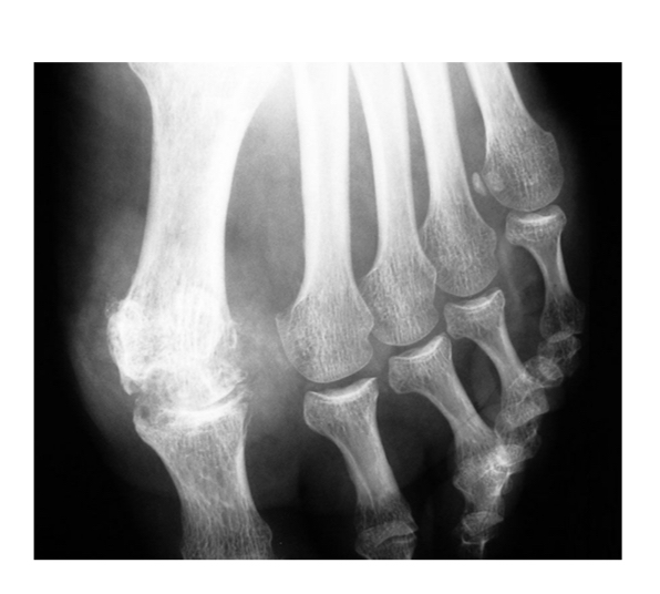 <ul><li><p>pincement global +condensation 1ere MTP </p></li><li><p>Érosions </p></li><li><p>Infiltration des parties molles </p></li></ul><p></p>