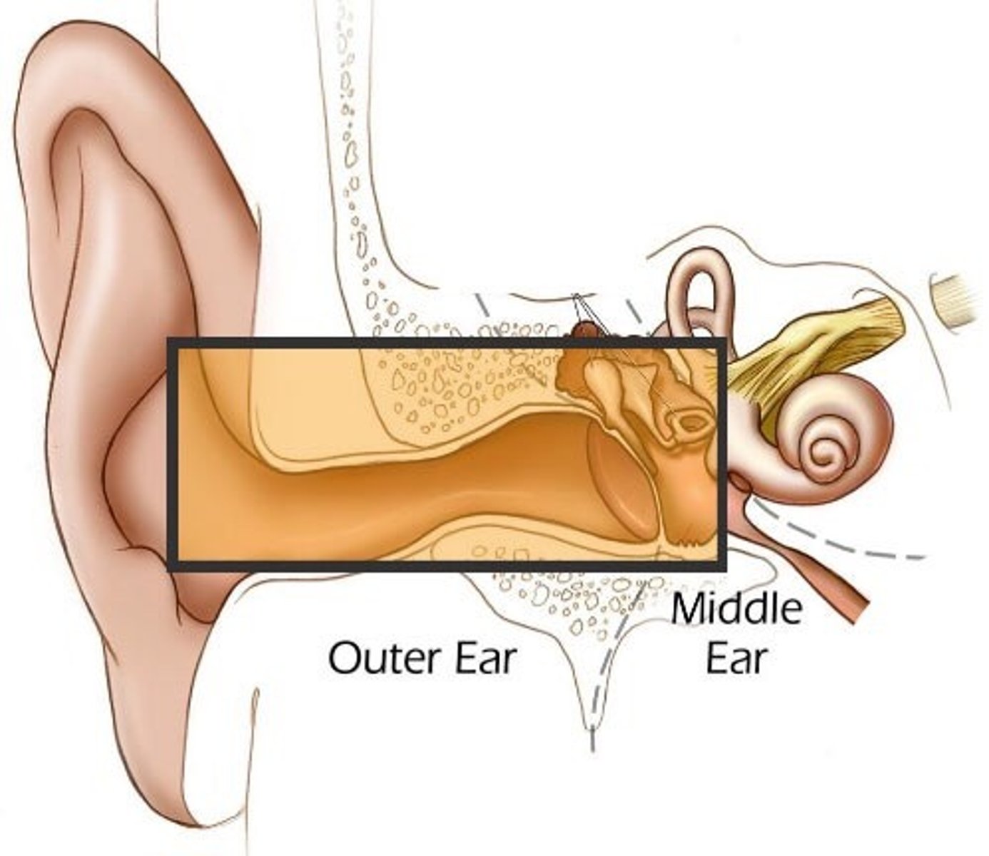 <p>Hearing loss caused by damage to the mechanical system (eardrum and ossicles) that conducts sound waves to the inner ear (cochlea)</p>